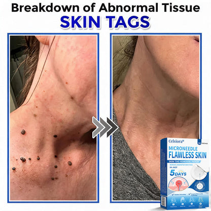 👑👑Celsiora® 2-in-1 Microneedle & Hydrocolloid Patch | Raised Moles,Acne, Flat Warts & Skin Tags Remover | Improves Wrinkles, Scars & Blemishes | Invisible Pimple Patches for Face & Body | 24 Count