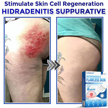 👑👑Celsiora® 2-in-1 Microneedle & Hydrocolloid Patch | Raised Moles,Acne, Flat Warts & Skin Tags Remover | Improves Wrinkles, Scars & Blemishes | Invisible Pimple Patches for Face & Body | 24 Count