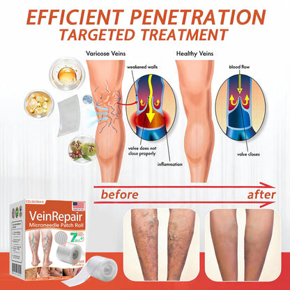 🌿🌿Official US Store 🇺🇸 | Celsiora® Vein Ease Microneedle Care Patch(For Spider Veins, Varicose Veins, Swelling & Leg Fatigue) - Last Day Promotion 50% OFF