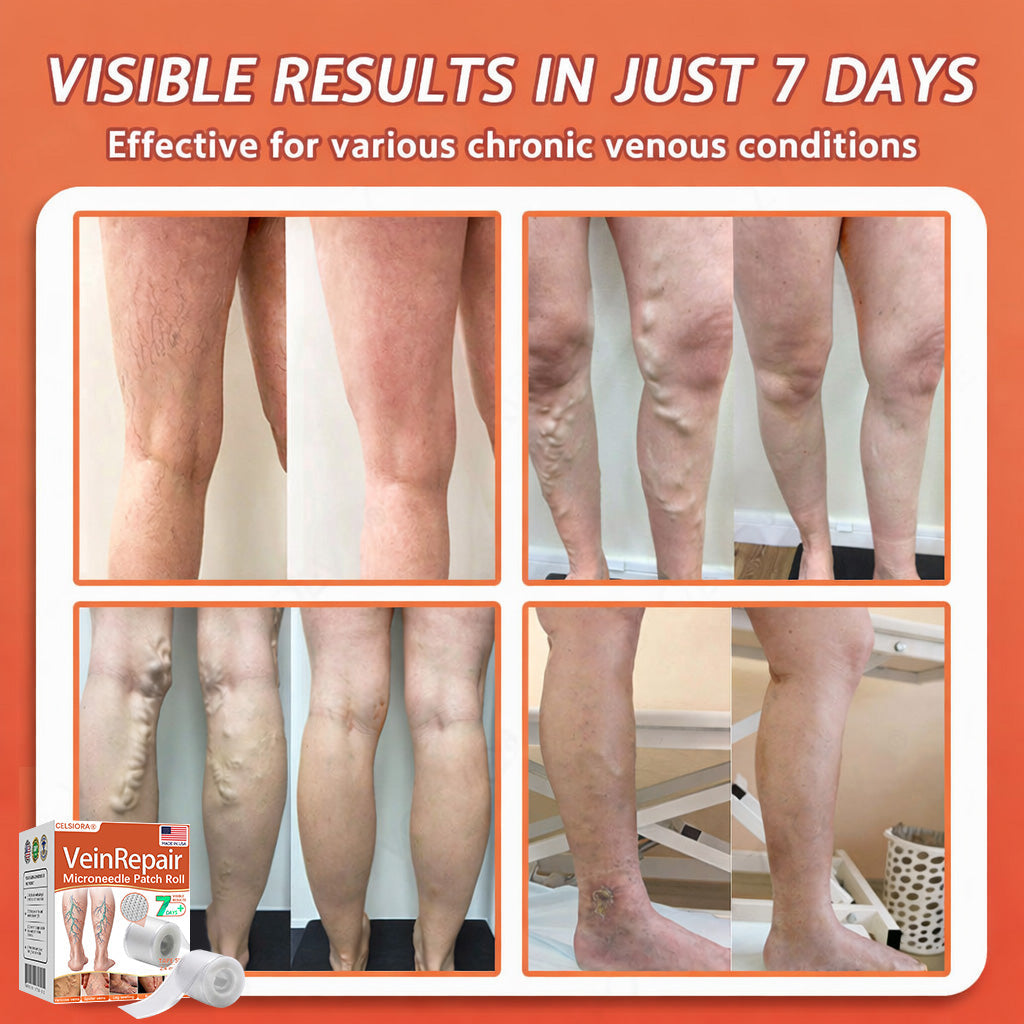 🌿🌿Official US Store 🇺🇸 | Celsiora® Vein Ease Microneedle Care Patch(For Spider Veins, Varicose Veins, Swelling & Leg Fatigue) - Last Day Promotion 50% OFF