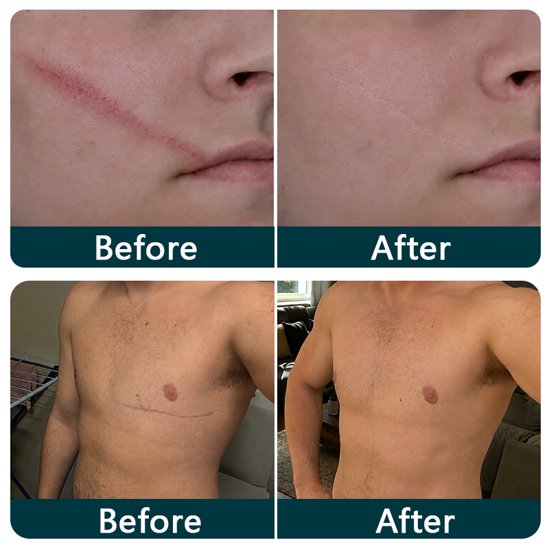 🇺🇸🎁🧚TRILUMIA® SILICONE SCAR THERAPY ROLL Help Soften, Flatten & Improve the Appearance of Raised Scars