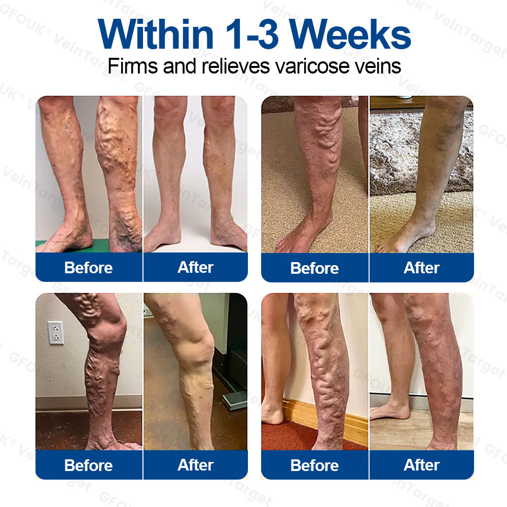 🇺🇸✅👨‍⚕️GFOUK® VeinTarget Microneedle Patch⚡Instant Relief, Long-Term Results