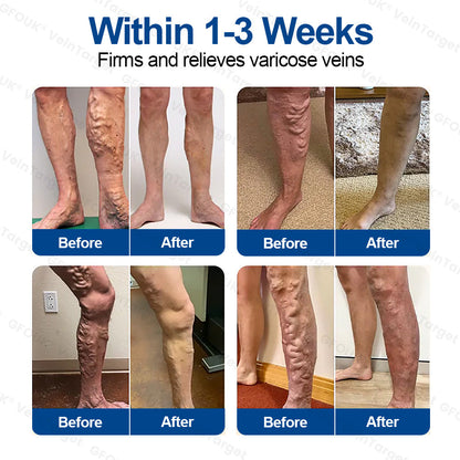 🇺🇸✅👨‍⚕️GFOUK® VeinTarget Microneedle Patch⚡Instant Relief, Long-Term Results