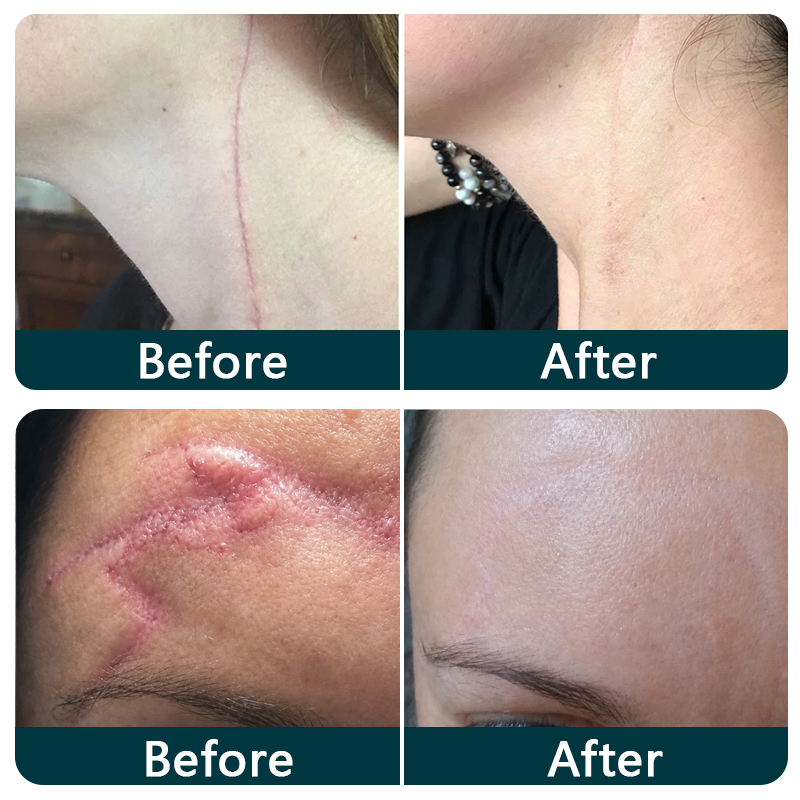 🇺🇸👩‍⚕️✨Trilumia® Silicone Scar Therapy Roll — Custom-Fit Care for Long, Raised Surgical Scars