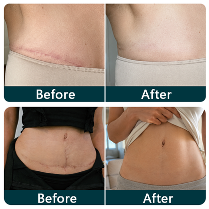 🇺🇸👩‍⚕️✨Trilumia® Silicone Scar Therapy Roll — Custom-Fit Care for Long, Raised Surgical Scars