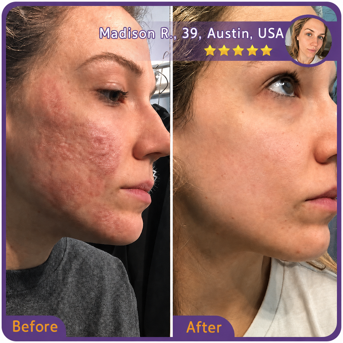 🇺🇸💯✨Trilumia® Medical-Grade Silicone Scar Repair Roller (For Raised, Red, Firm, Tight & Discolored Post-Surgical Scars)