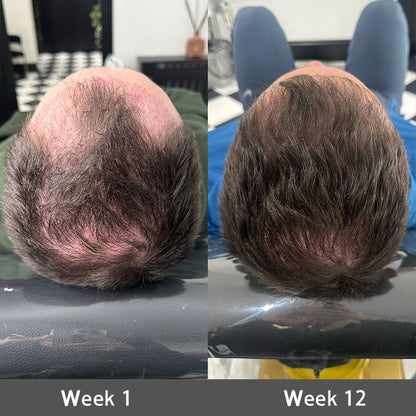 👨‍⚕️🔥Official US Store 🇺🇸 | 🔥Rolimey® Highly Effective Biotin & Rosemary Hair Growth Serum — Visibly fills thinning areas & receding hairlines (🔥 Limited-Time Offer, ⏳ Last 30 Minutes)