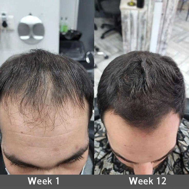 👨‍⚕️🔥Official US Store 🇺🇸 | 🔥Rolimey® Highly Effective Biotin & Rosemary Hair Growth Serum — Visibly fills thinning areas & receding hairlines (🔥 Limited-Time Offer, ⏳ Last 30 Minutes)