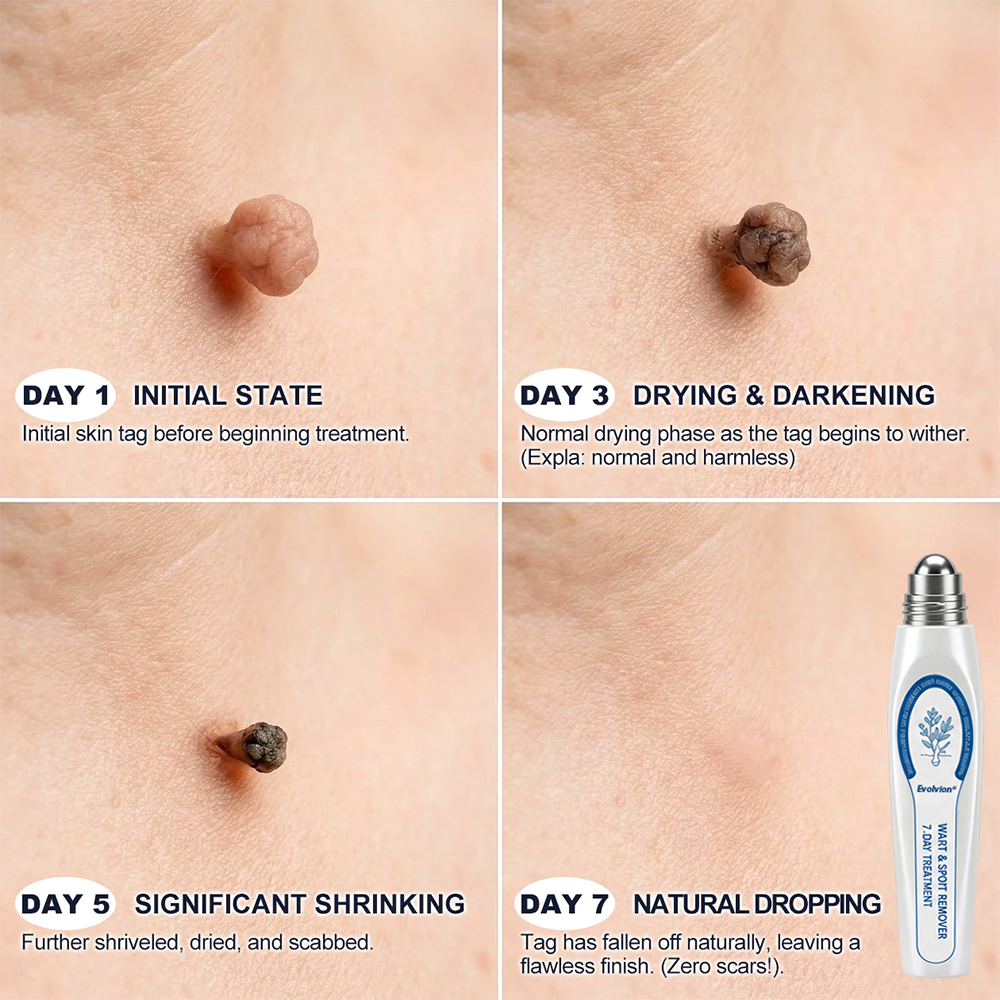 ✨🌿Evolvion® 𝟕-𝐃𝒂𝘆 𝐒𝗸𝐢𝐧 𝐓𝒂𝗴 & 𝐒𝐩𝙤𝐭 𝐄𝐫𝒂𝐬𝙚𝐫 Painless & Scar-Free Advanced Imperfection Remova𝗜 Ro𝗜𝗜erba𝗜𝗜 Pen