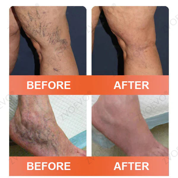🌿🌿Official US Store 🇺🇸 | Celsiora® Vein Ease Microneedle Care Patch(For Spider Veins, Varicose Veins, Swelling & Leg Fatigue) - Last Day Promotion 50% OFF