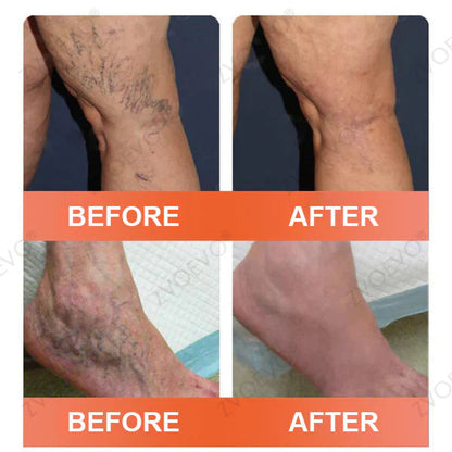 🌿🌿Official US Store 🇺🇸 | Celsiora® Vein Ease Microneedle Care Patch(For Spider Veins, Varicose Veins, Swelling & Leg Fatigue) - Last Day Promotion 50% OFF