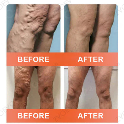🌿🌿Official US Store 🇺🇸 | Celsiora® Vein Ease Microneedle Care Patch(For Spider Veins, Varicose Veins, Swelling & Leg Fatigue) - Last Day Promotion 50% OFF